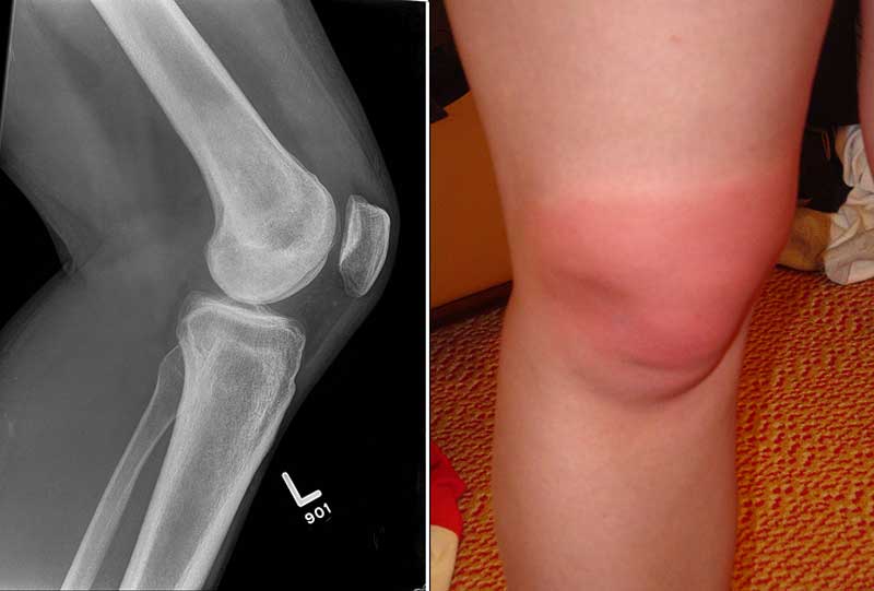 ondt i knæet på ydersiden indersiden foran eller bag knæet
