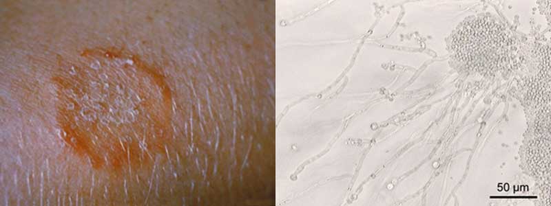 Hudsvamp symptomer og svamp i huden